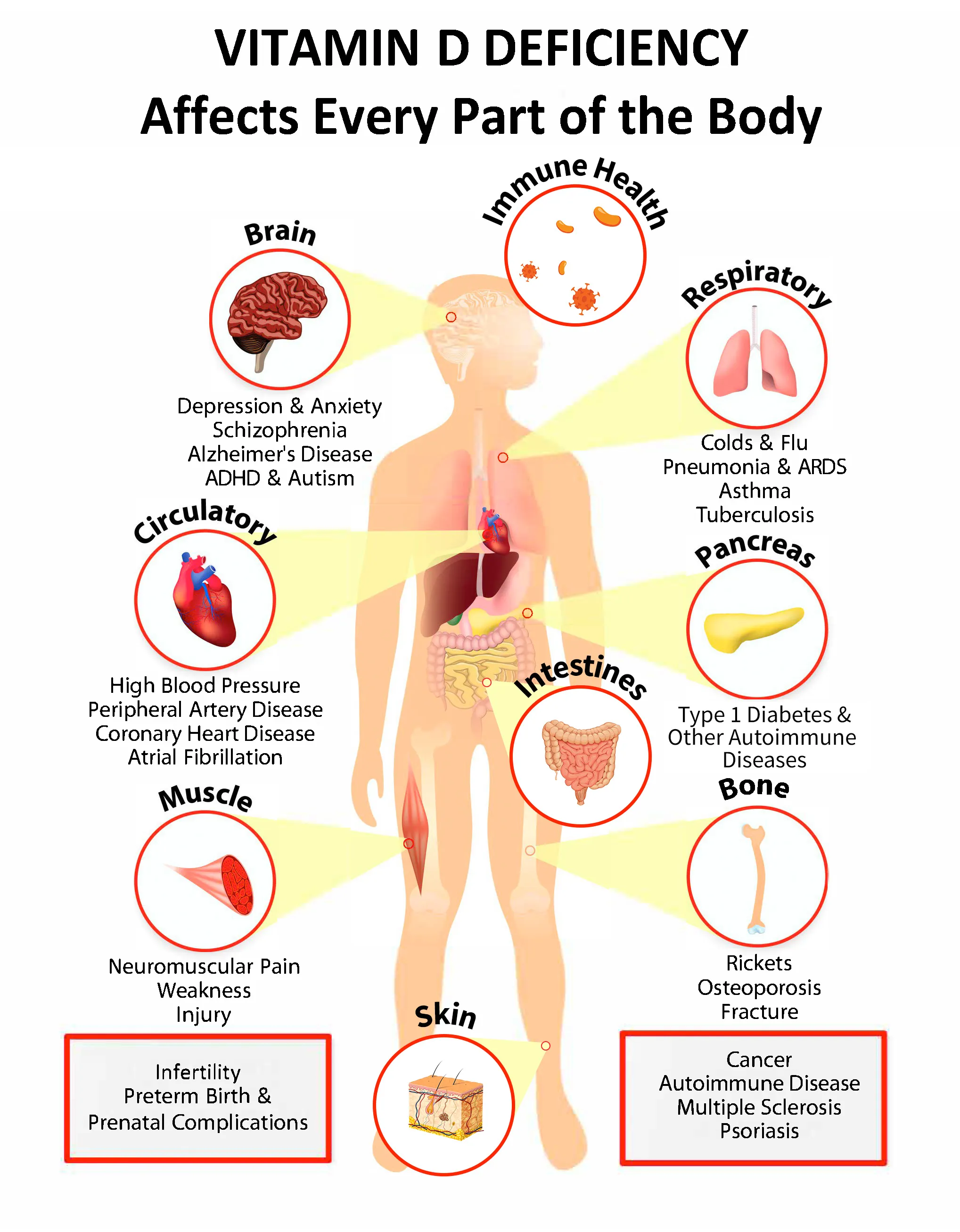 vitamin d deficiency